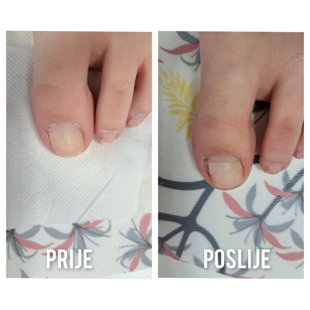 Urasli nokti najčešće se pojavljuju na nožnom palcu. Kada uraste u noktni kanal nastaje bolna oteklina i gnojne infekcije. Saznajte što je to španga ili kopča za urasle nokte. 