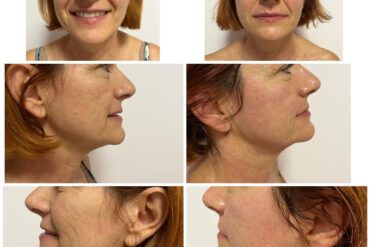 NOVO: 4 Meganova tretmana i njihova učinkovitost na koži lica i vrata